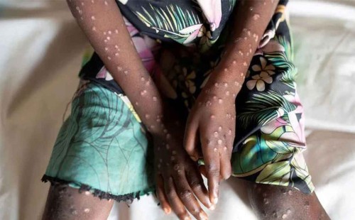 দ্রুত ছড়াচ্ছে মাঙ্কিপক্স, বিশ্বজুড়ে জরুরি অবস্থা 