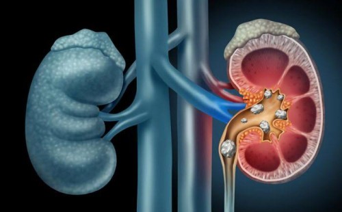 কিডনিতে পাথরের লক্ষণ 