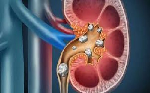 কিডনিতে পাথরের চিকিৎসা 