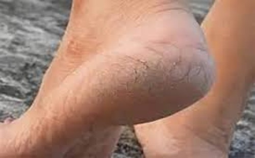 শাক খেলেও সারে পা ফাটা 