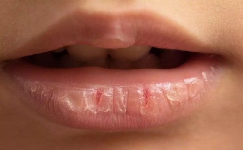 ঠোঁট ফাটে যে ভিটামিনের অভাবে 