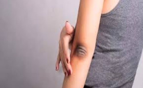 হাঁটু-কনুইয়ের কালো দাগ দূর করার উপায় 