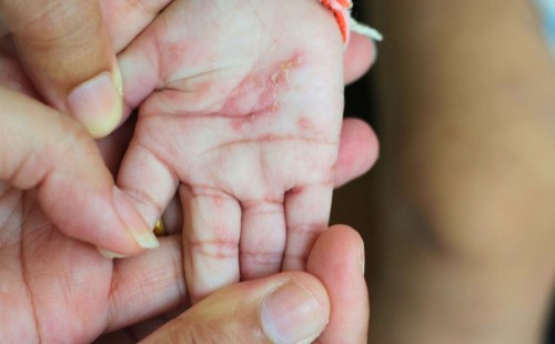 গরমের চুলকানি নয়, স্ক্যাবিস! যেসব কারণে সতর্ক থাকবেন 