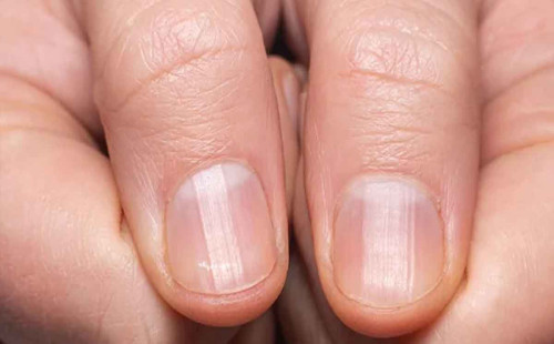 নখ দেখেই যেভাবে বুঝবেন রোগের লক্ষ্মণ 