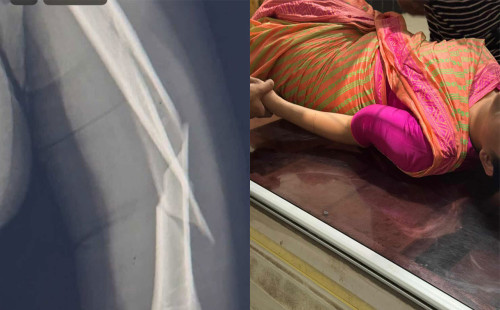 মাঝ আকাশে বিমানের কেবিন ক্রুর হাত ভাঙলো 