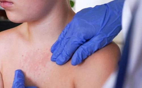 যুক্তরাষ্ট্রে হাম মহামারি আরও বাড়ছে 